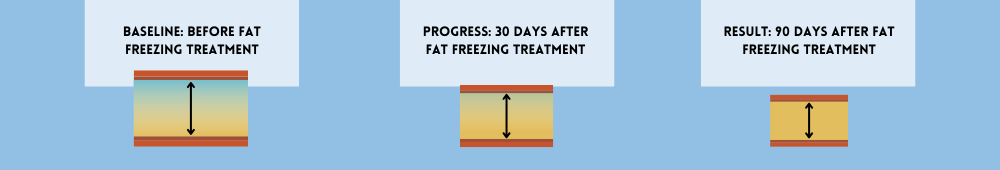 The Fat Freezing Process in Pinner